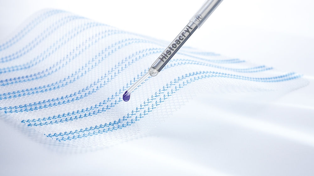 Surgical mesh with the Histoacryl® LapFix applier for mesh fixation