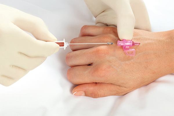 Removing steel needle of a Introcan Safety® 3 cannula which is placed by a healthcare worker who is wearing gloves. Blood chamber is filled with blood.