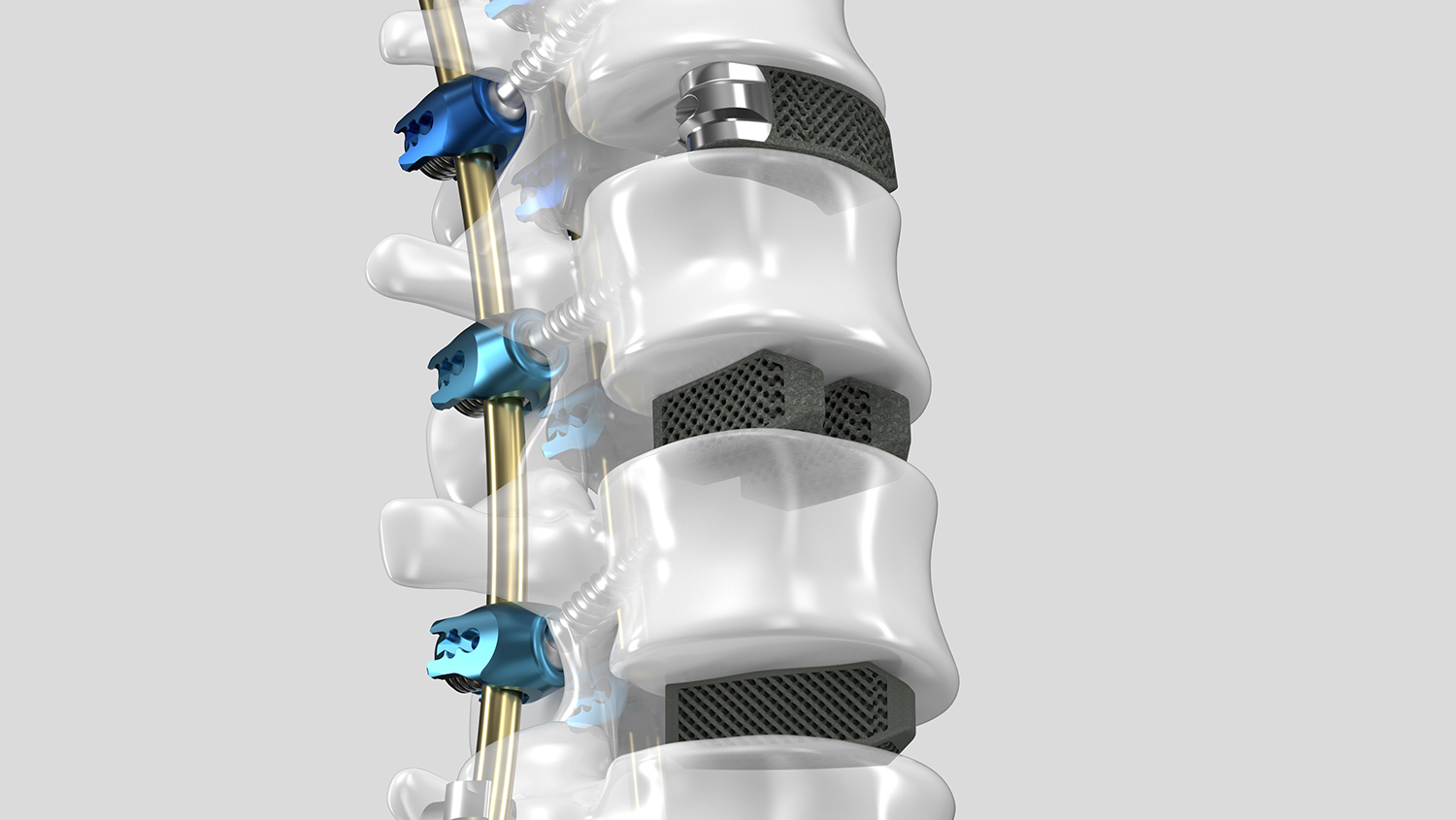 Spine model with 3D printed Interbody Fusion devices