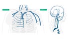 misplacement superior vena cava