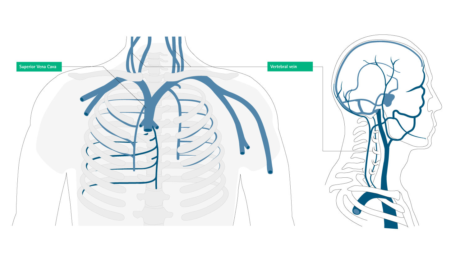 misplacement superior vena cava