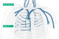 misplacement azygos vein