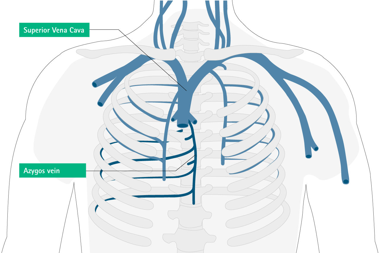 misplacement azygos vein