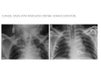 clinical cases with misplaced cvcs