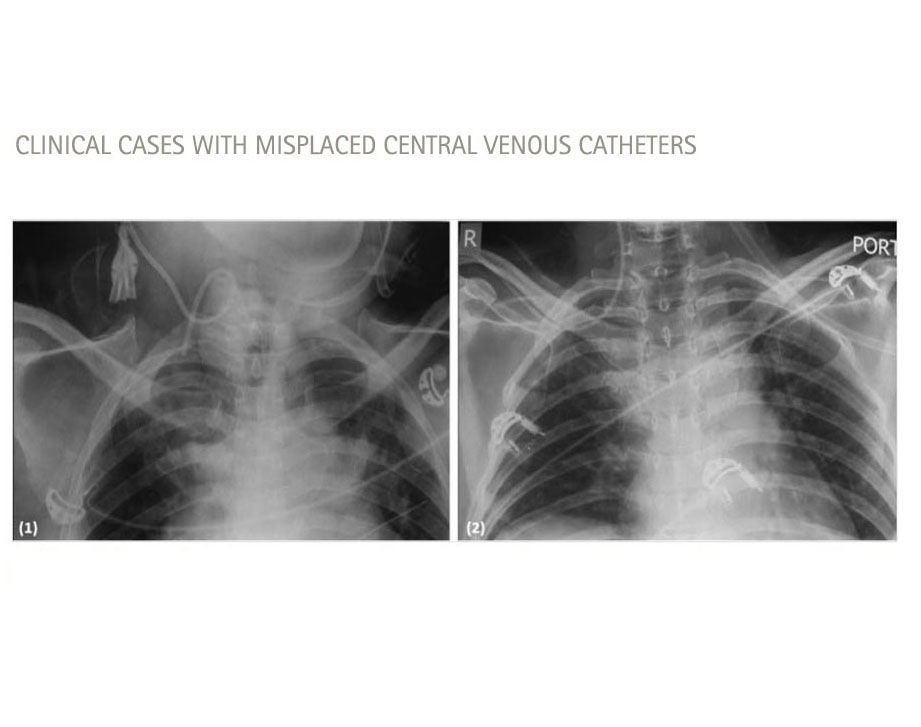 clinical cases with misplaced cvcs