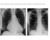 post operative chest radiograph