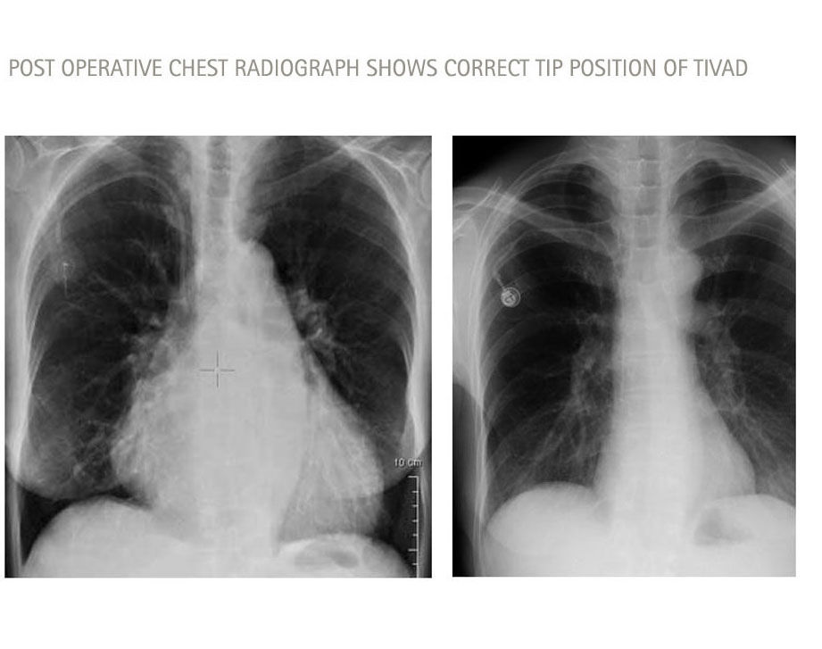 post operative chest radiograph