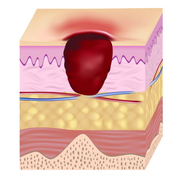 Illustration: Stage 3 pressure ulcer