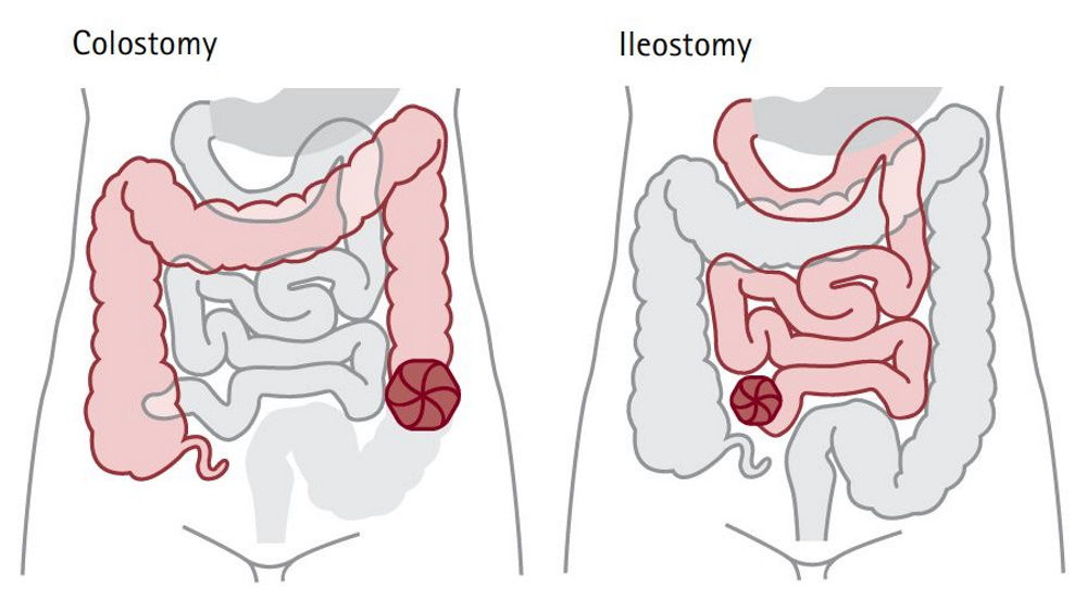 colostomy and ileostomy illustration