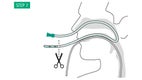 Illustration: Transnasal channelling – Feed a 16 CH gastric tube in through the nose and out through the mouth. Cut off the atraumatic tip.