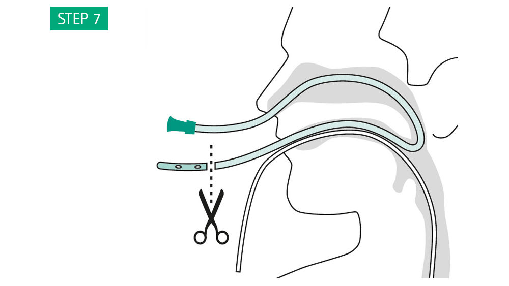 EsoSPONGE® endoluminal vacuum therapy in the upper GI tract