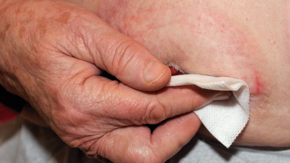 hand is cleaning the stoma