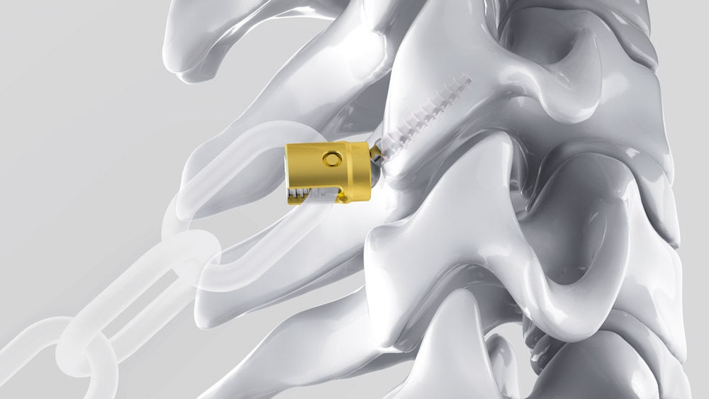 Illustration of an Ennovate® Cervical screw positioned within a cervical vertebra, with an attached chain applying tensile load to illustrate pull‑out resistance.