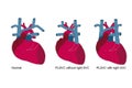 misplacement heart overview