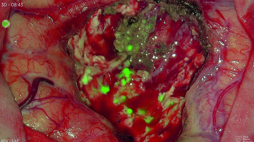 Glioblastoma White Light