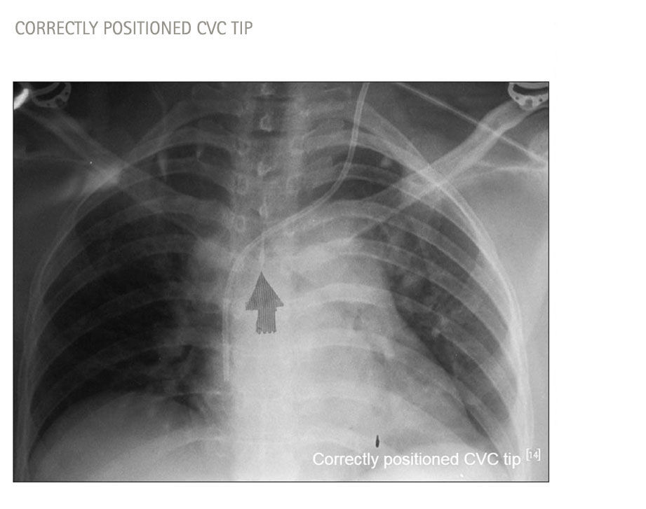 x-ray misplaced catheter