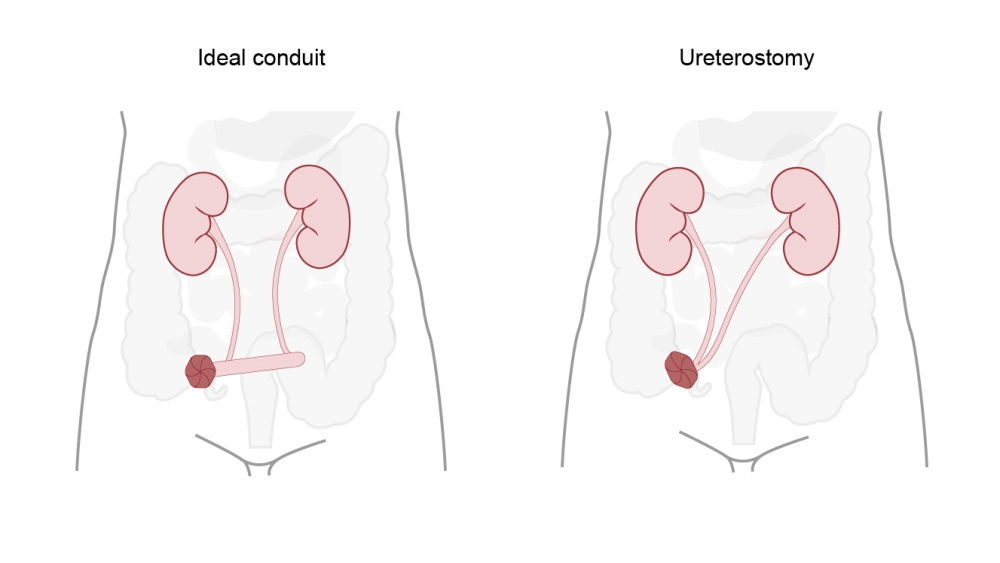 ileal condui and ureterostomy illustration