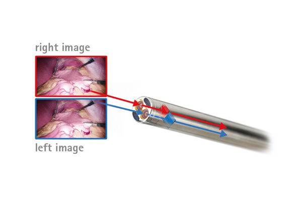 Example of chip-on-the-tip 3D camera systems