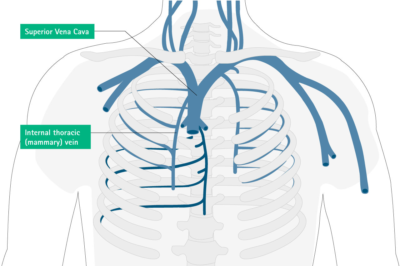 misplacement internal thoracic vein