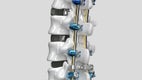 Spine model with Ennovate® and 3D Cages