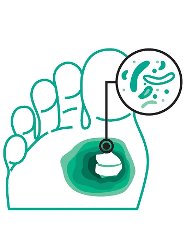 Foot icon with larger highlighted area and bacteria inset on the bone, indicating moderate infection.