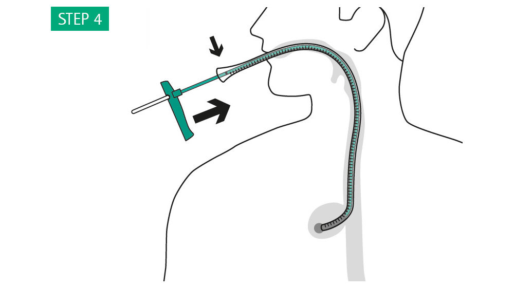 Illustration: Push the Eso-SPONGE® to the mark with the pusher. The sponge is now at the end of the overtube (uncut sponge).