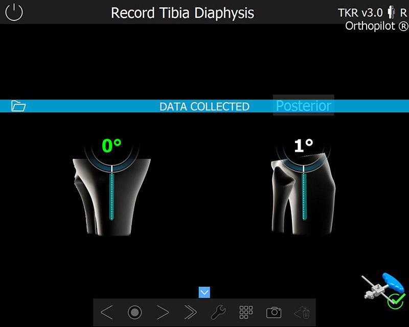 Screenshot of the OrthoPilot® TKR software – Record tibia diaphysis