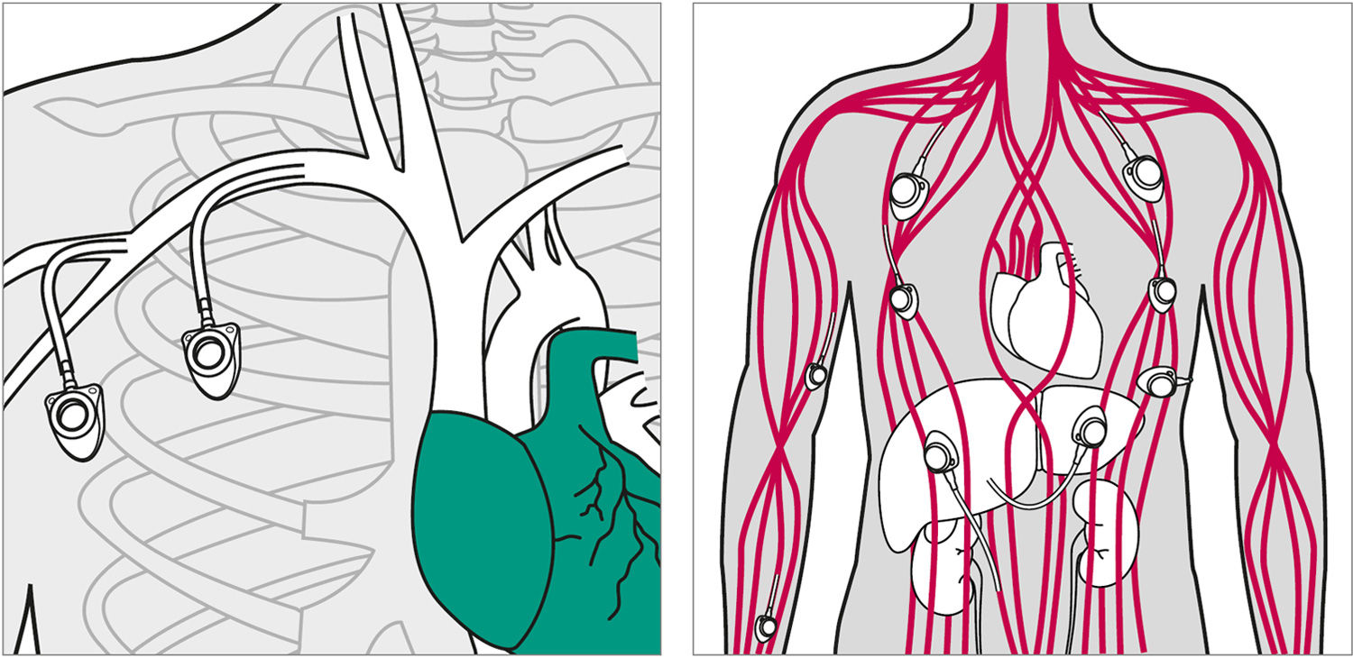 Illustrations of the potential access routes for a central venous vascular port catheter