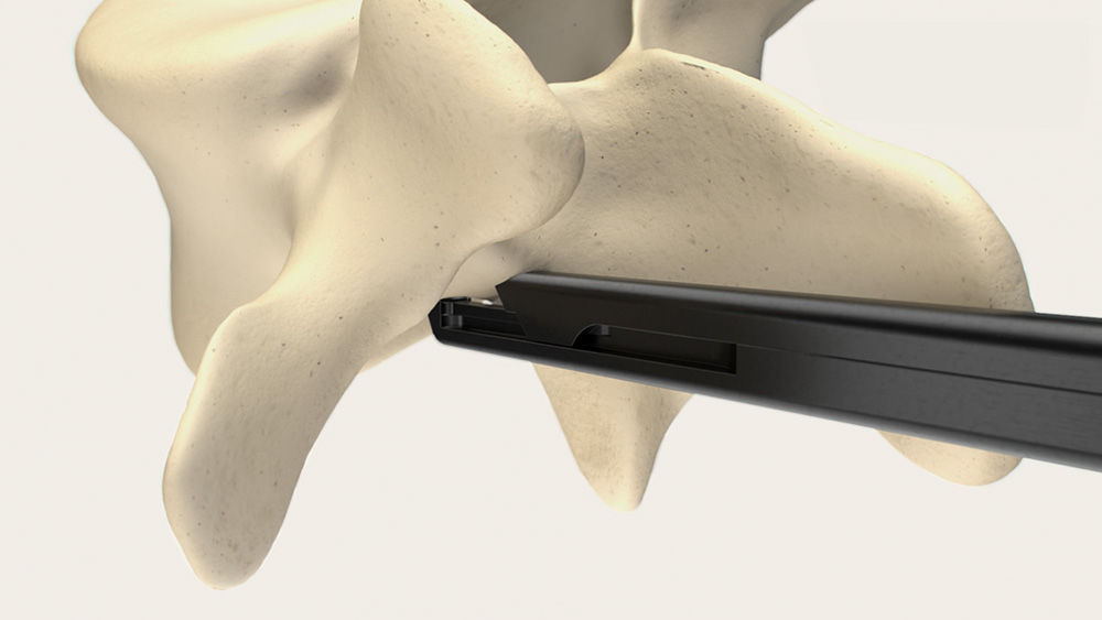 Usage of the SQ.line® KERRISON while cutting  away small sections of bone