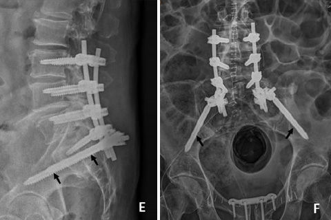X-Rays of the spine with implants