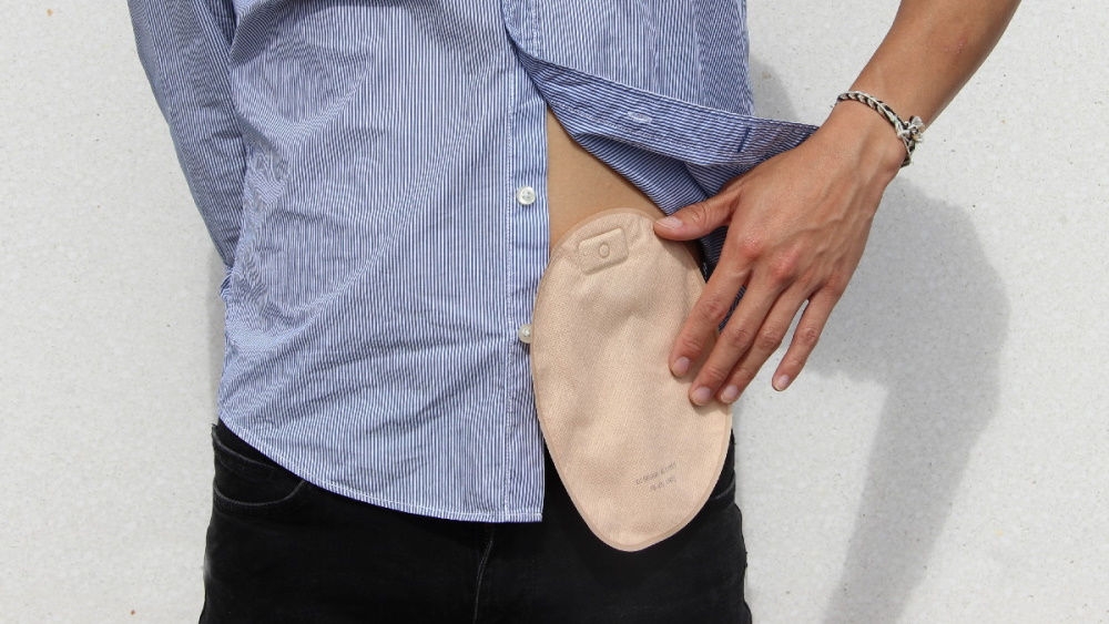 man with blue shirt holding his hand on his stoma bag