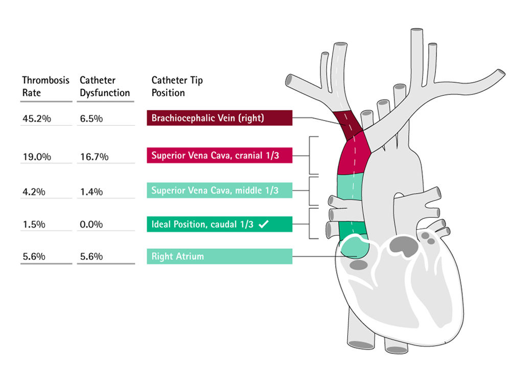 scheme of catheter tip position