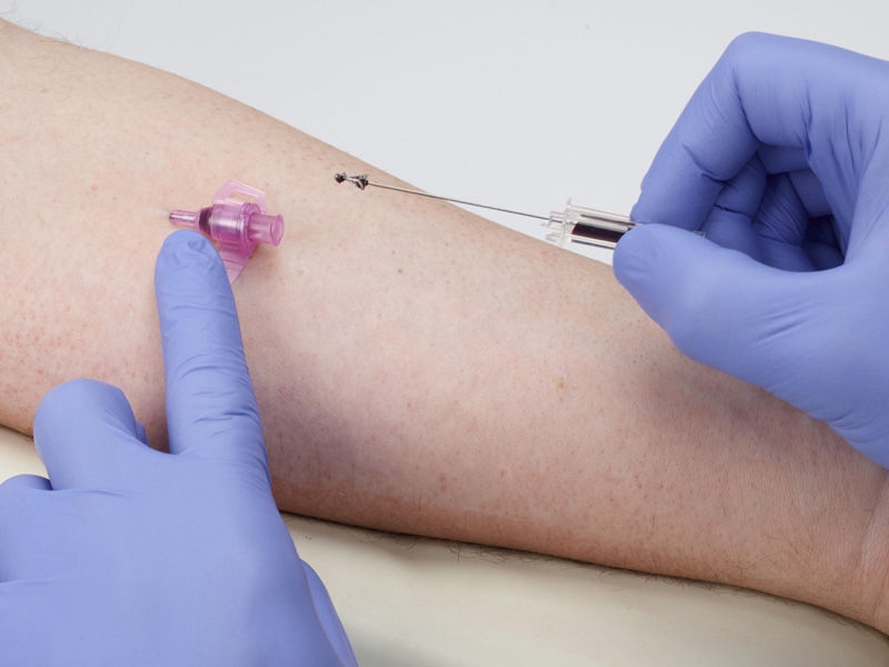 Removing a venipuncture puncture needle with integrated safety clip of a Introcan Safety® cannula placed in a patients arm. Patient blood is in the blood chamber. Handling done by a person with blue gloves.