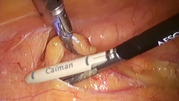 EinsteinVision® in laparoscopic surgery with autofocus effect