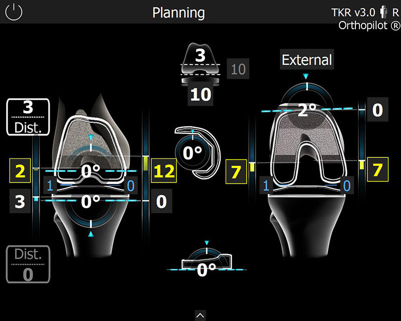Screenshot of the OrthoPilot® TKR software – Planning