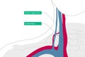 misplacement internal ugular vein