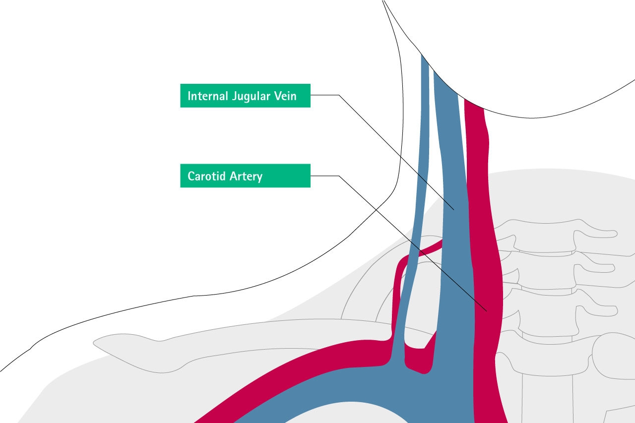 misplacement internal ugular vein