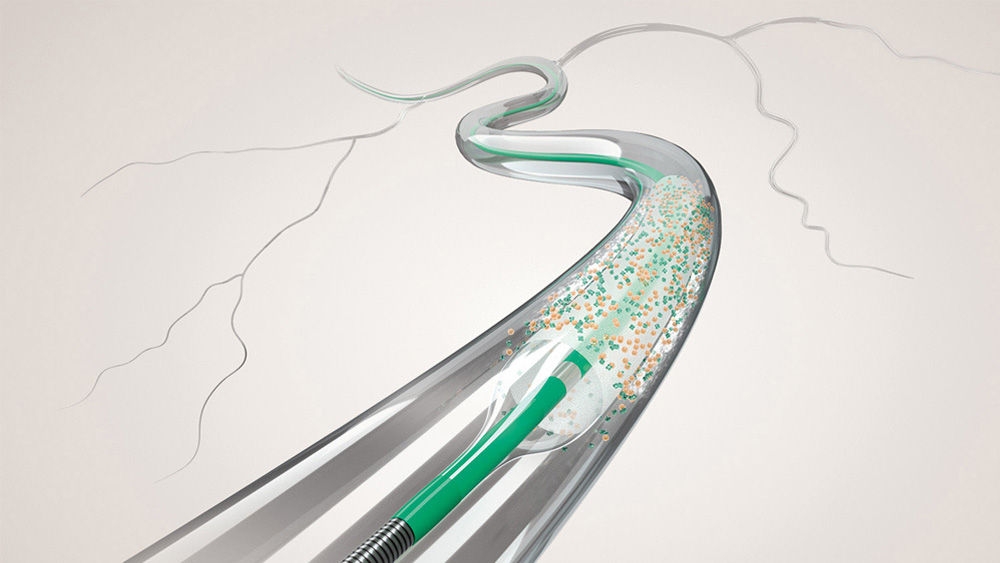 A coronary drug-coated balloon used in angioplasty of a calcified coronary artery lesion.