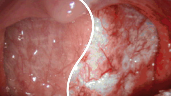 EinsteinVision® in laparoscopic surgery with red enhancement