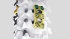 Ennovate® Cervical with AESCULAP® CeSPACE® 3D and Quintex®