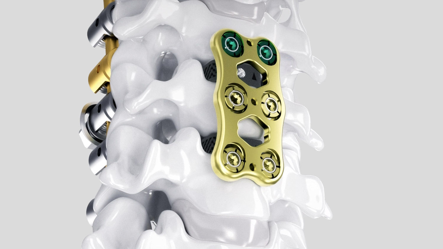 Ennovate® Cervical with AESCULAP® CeSPACE® 3D and Quintex®