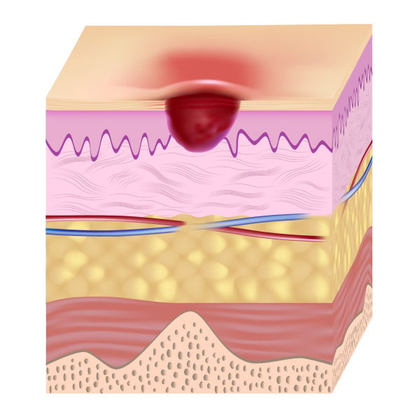 Illustration: Stage 2 pressure ulcer