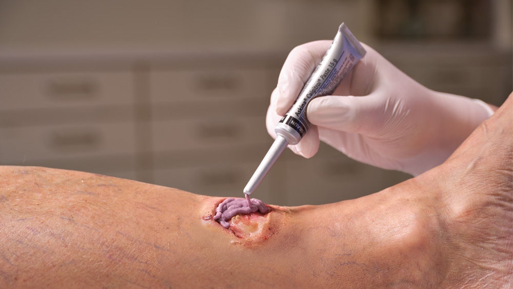 Image showing a close-up of a leg with an open wound being treated with Askina Calgitrol Paste dressing, being applied by a nurse. The wound appears inflamed with surrounding redness, highlighting a medical care or wound treatment context.