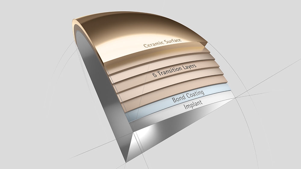 Knee implant with multilayer surface coating for allergic patients 