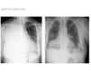 limits of chest x-ray