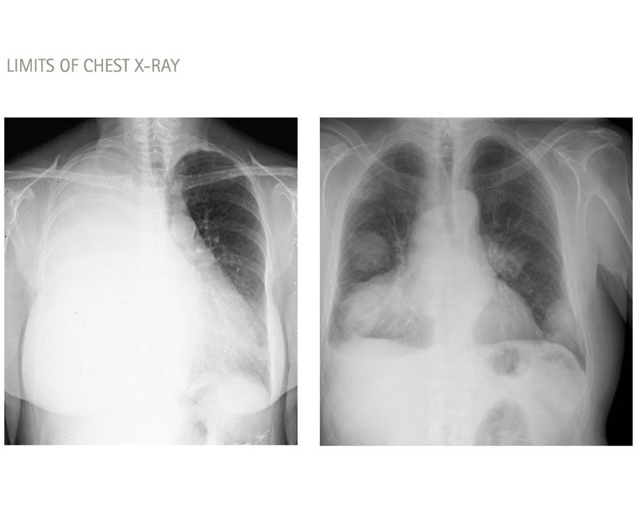 limits of chest x-ray