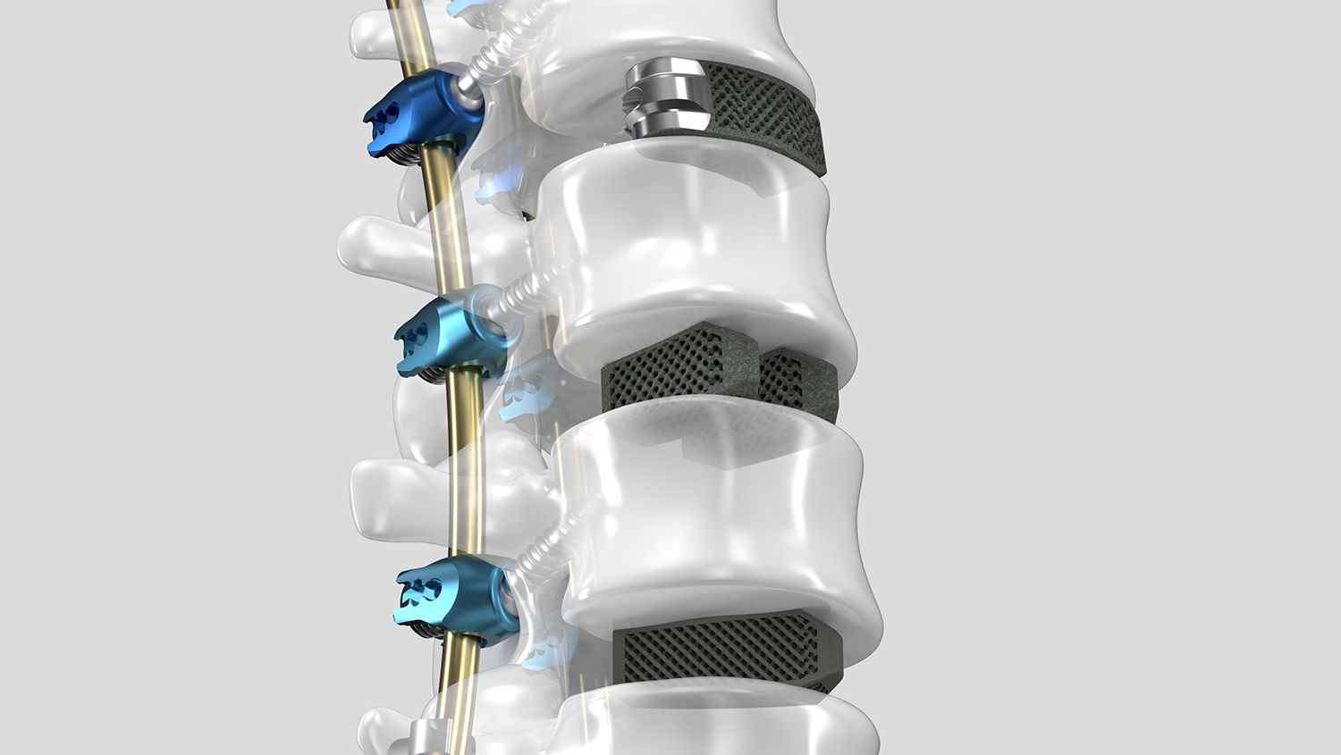 Ennovate® Thoracolumbar & Sacropelvic with AESCULAP® 3D Interbody fusion devices