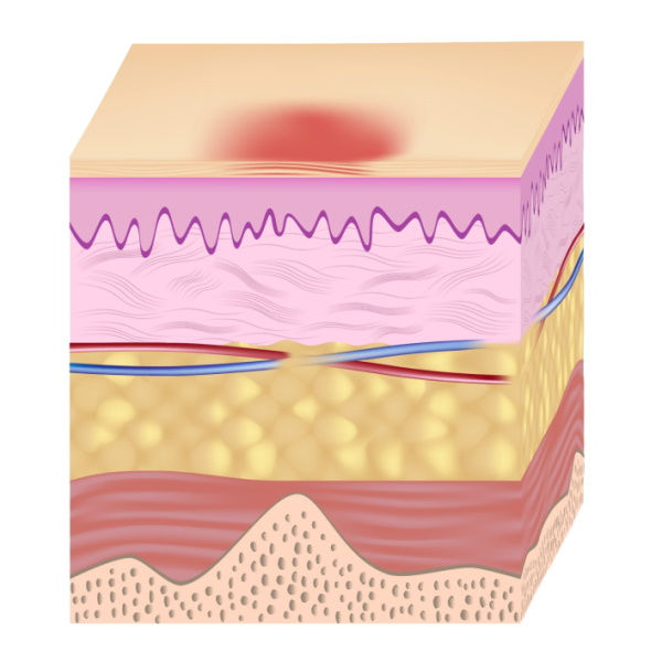 Illustration: Stage 1 pressure ulcer