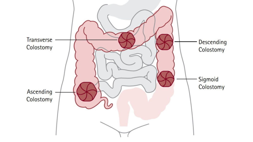 transverse, descending, ascending and sigmoid colostomy illustration