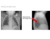 pitfalls of chest x-ray